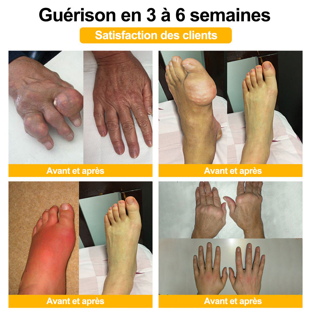 Purelora® Venin d'abeille Crème cicatrisante osseuse Pain-Relief 🐝🐝(Spécialement conçu pour les personnes âgées & Recommandé par Chirurgien)