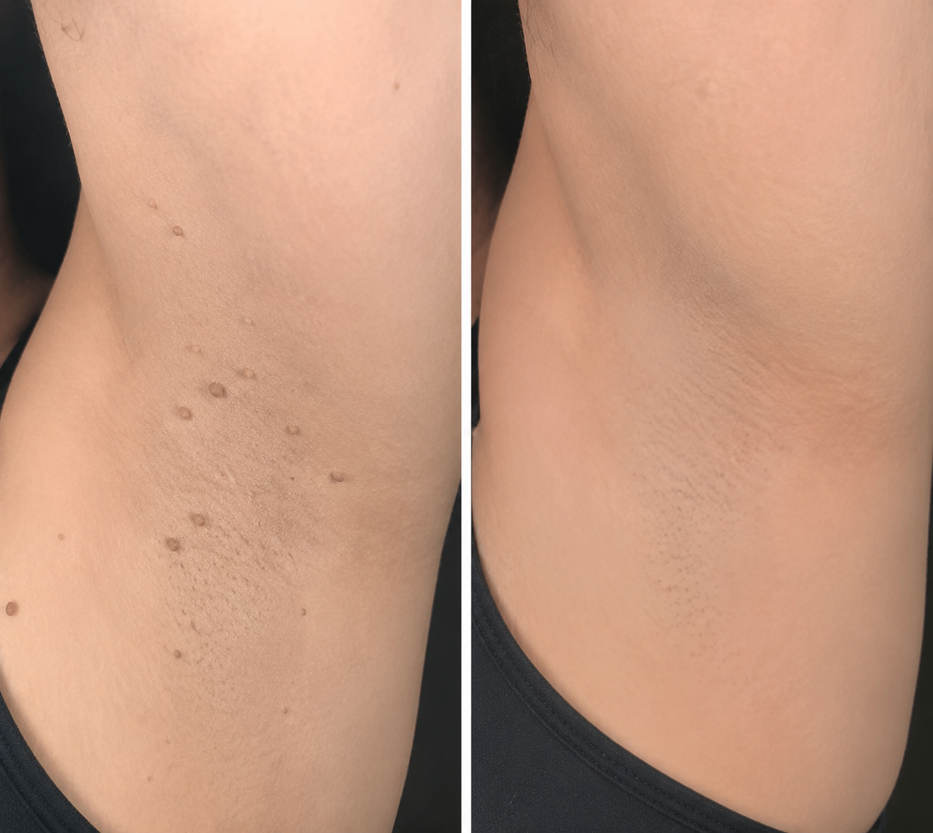 ✨Curalona® Patch micro-aiguilles et hydrocolloïde 2 en 1🍀 | Élimine les grains de beauté en relief, l'acné, les verrues planes et les acrochordons | Atténue les rides, les cicatrices et les imperfections | Patchs invisibles pour le visage et le corps